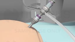 Robotic Gastric Sleeve