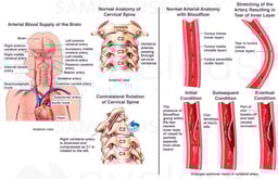Whiplash Injury - Vertebral Artery Damage