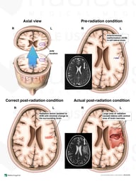 Over Radiation of Intracranial AVM with Resulting Brain Injury