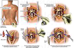 L4, L5 Laminectomy, Discectomy and Spinal Fusion