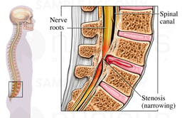 Spinal Stenosis of the Lumbar Spine
