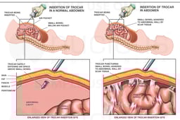 Inappropriate Insertion of Trocar with Traumatic Laceration of the Small Bowel