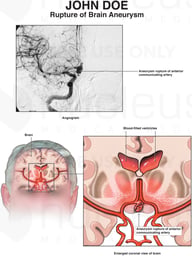 Rupture of Brain Aneurysm