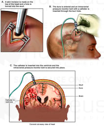 Recommended Procedure to Monitor and and Treat Intracranial Pressure