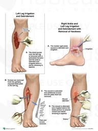 Additional Irrigation and Debridement Procedures