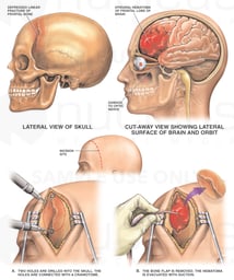 Post-accident Head Injury with Subsequent Craniotomy Procedure
