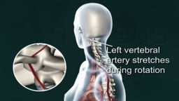 Left Vertebral Artery