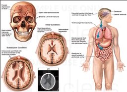 Cranial Injuries and VP Shunt