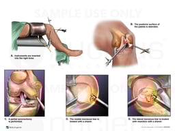 Arthroscopic Meniscectomy and Synovectomy of the Right Knee