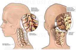 Female Head and Neck with Post-accident Facet Syndrome and Chronic Neck Pain