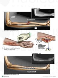 Right Radial Shaft Fracture with Surgical Fixation