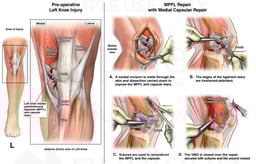 Left Knee Ligament Tear with Surgical Repair