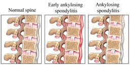 Stages of Ankylosing Spondylitis