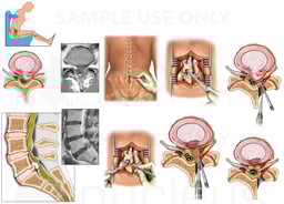Traumatic Lumbar Spine Injuries with Repairs
