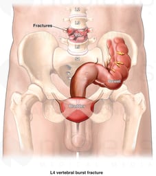 Lumbar Spine Fractures Causing Nerve Damage
