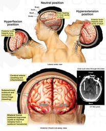 Brain Injury