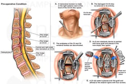 Cervical Spine Injury with Initial Surgical Repair