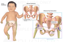 Bilateral Hip Dislocation