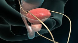 Radical Prostatectomy