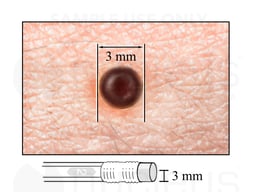 Normal Mole