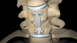 Cervical Spinal Fusion