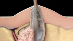 Clogged Hair Follicle