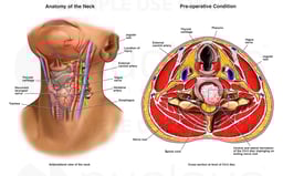 Location of Cervical Disk Injury