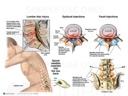 Lumbar Spine Injury with Attempts at Pain Management