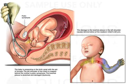 Shoulder Dystocia with Brachial Plexus Injury