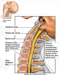 C3 to C7 Multilevel Cervical Spine Injury