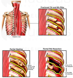 Progression from Healing Rib Fracture to Permanent Disabling Nerve Pain Syndrome