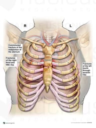 Traumatic Chest Injuries