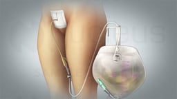 Caring For Your Suprapubic Catheter: Discharge Instructions