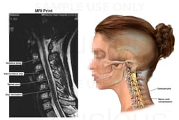 Cervical Spine Injury