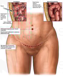Female Abdomen with Sites of Multiple Abdominal Surgeries