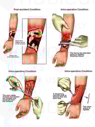 Deep Third Degree Burns with Surgical Conditions