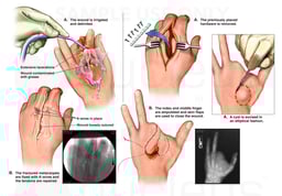 Multiple Surgical Procedures