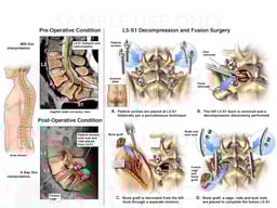 Lumbar Spine Injuries with Surgical Fusion