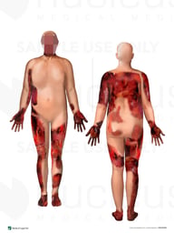 Widespread Burn Injuries