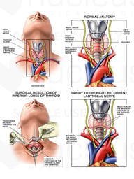 Subtotal Thyroidectomy with Subsequent Nerve Damage