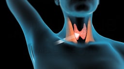 Robotic Thyroidectomy