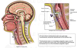 Improper Placement of Tracheostomy