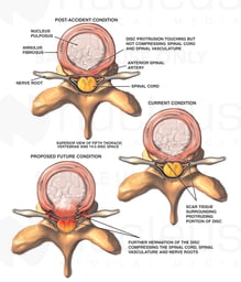 Thoracic Disc Herniation with Scarring