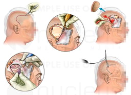 Brain Surgery