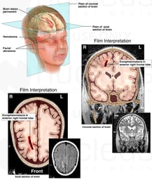 Traumatic Brain Injury