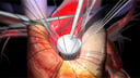 Aortic Valve Replacement