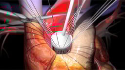 Aortic Valve Replacement