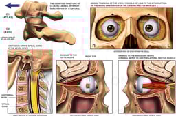 C1 Subluxation on C2 with Injuries to the Optic Nerves