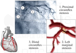 Coronary Angiogram