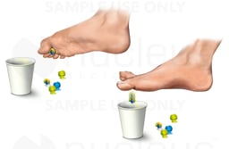 Plantar Fasciitis: Treatment Exercise